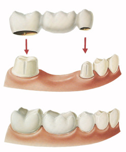 dental_bridge