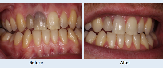 internal_whitening